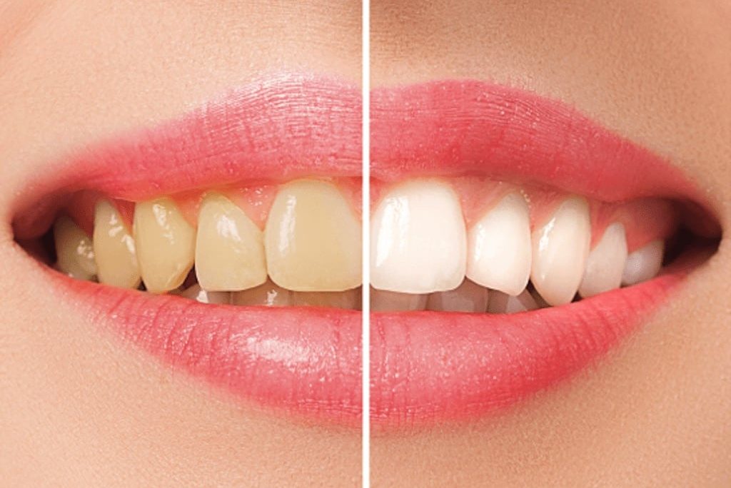 四環素牙-牙齒黃-採用陶瓷貼片的前後比對圖
