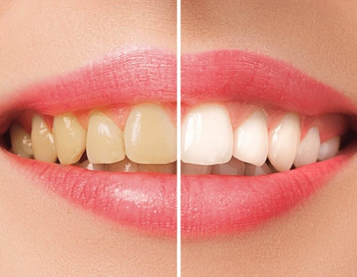四環素牙-牙齒黃-採用陶瓷貼片的前後比對圖