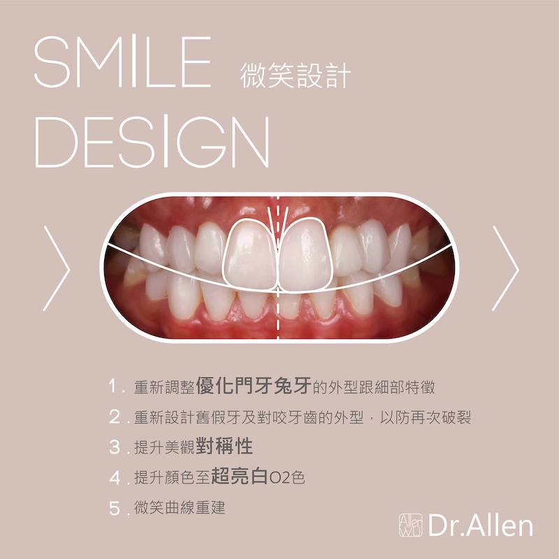 陶瓷貼片-DSD數位微笑設計-療程後-台中牙齒美白貼片-推薦-吳國綸醫師