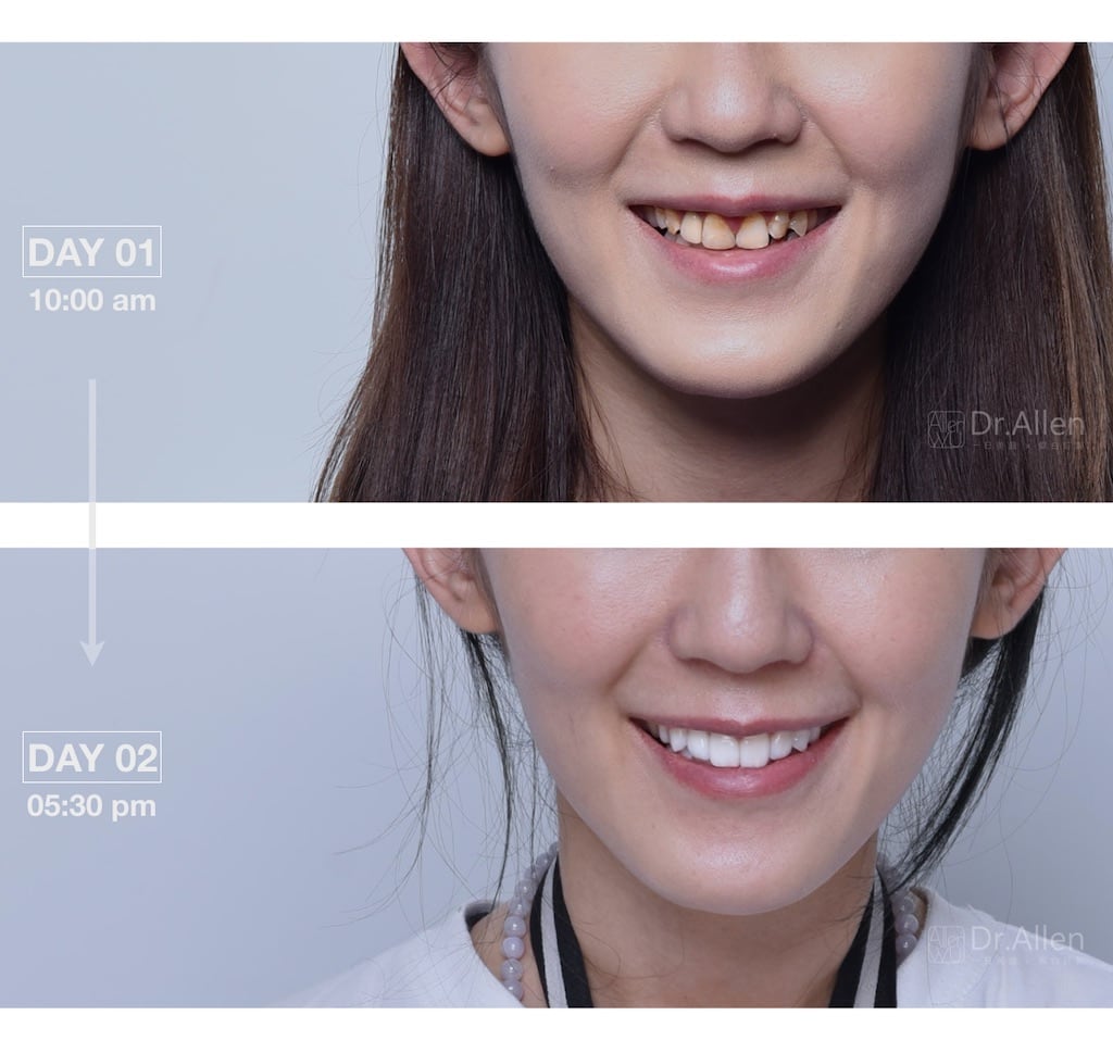 陶瓷貼片-推薦-台中牙齒美白-吳國綸醫師-瓷牙貼片一日美齒-牙齒美白貼片前後比較