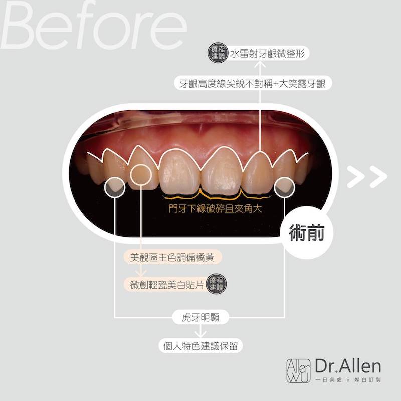 陶瓷貼片-牙齒矯正後牙齒黃-笑露牙齦-陶瓷貼片療程前-台中-吳國綸醫師