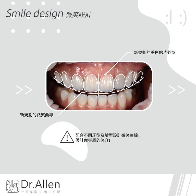 瓷牙貼片-牙齦微整型-牙齒矯正後美白-陶瓷貼片療程中-DSD微笑設計-陶瓷貼片-台中-吳國綸醫師