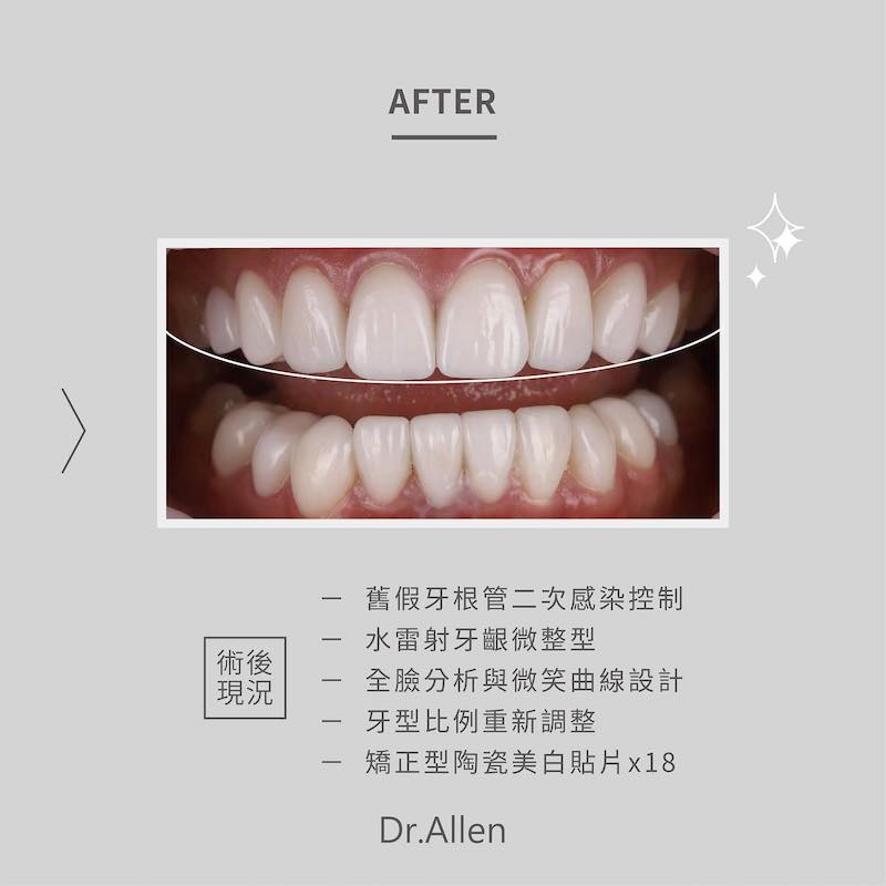 假牙蛀牙感染控制後，吳國綸醫師為陳婷前牙18顆牙齒裝上矯正型陶瓷貼片