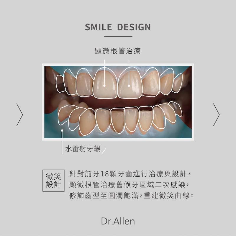 吳國綸醫師針對陳婷前牙18顆牙齒的治療規劃，假牙蛀牙治療後採水雷射牙齦整形改善牙齒形狀和微笑曲線