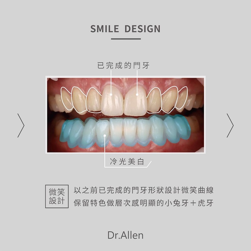 吳國綸醫師先為患者雨停完成上排兩顆門牙貼片，並保留特色牙形設計微笑曲線，下排牙齒將透過冷光美白提升齒色