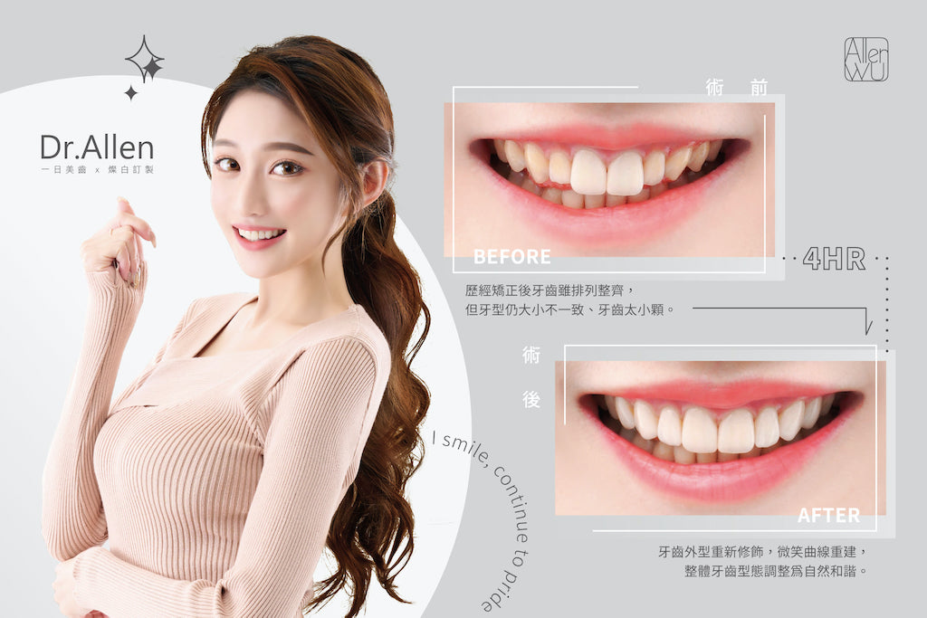 牙齒大小不一-牙齒微笑曲線-微笑設計-門牙貼片-推薦-台中-吳國綸醫師