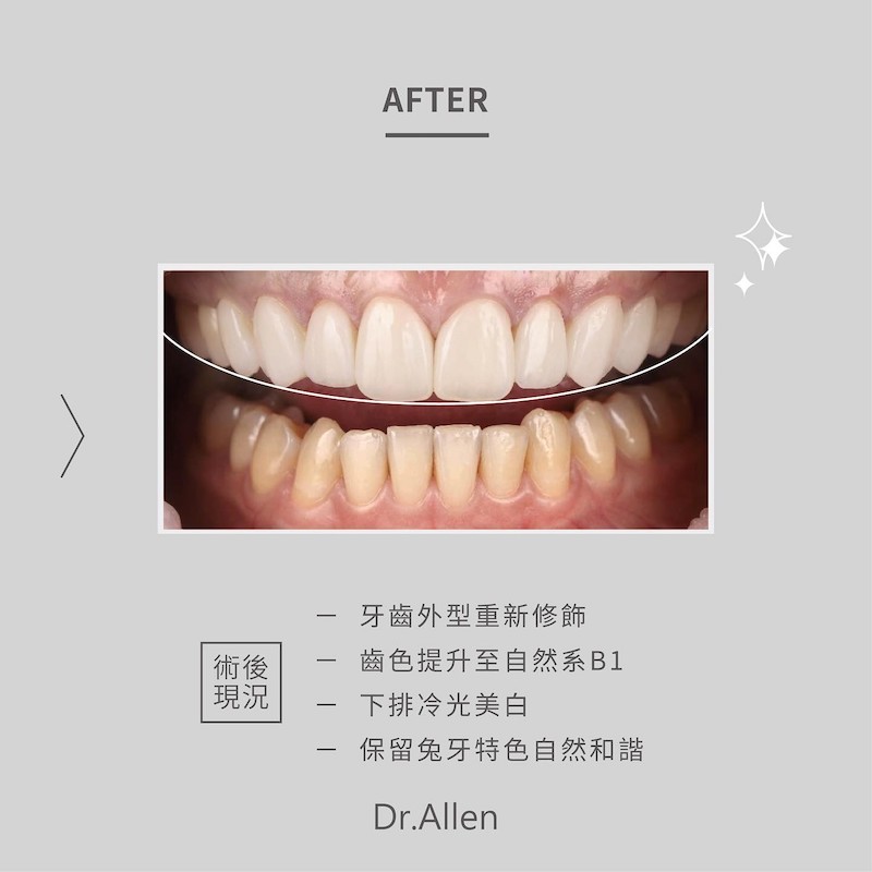 吳國綸醫師為患者雨停完成上排笑容美觀區的6顆陶瓷貼片，重新修飾牙齒外型並提升齒色，搭配下排牙齒冷光美白，完成微笑曲線重建改造