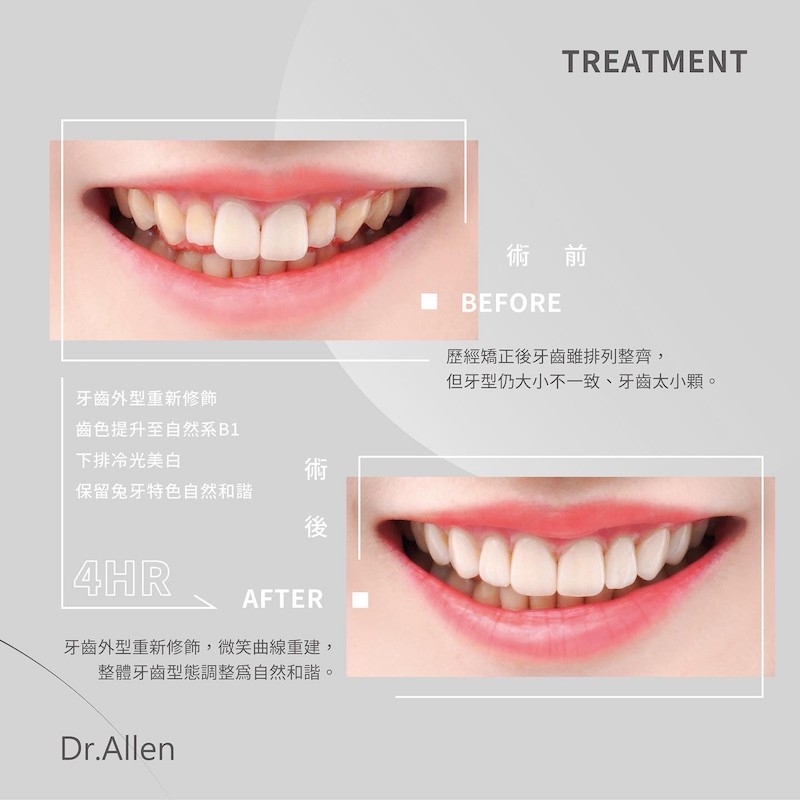 患者雨停陶瓷貼片療程前後的笑容對比，吳國綸醫師為她改善了牙齒大小不一、牙齒形狀尖、牙齒小顆，重建自然和諧的微笑曲線牙齒