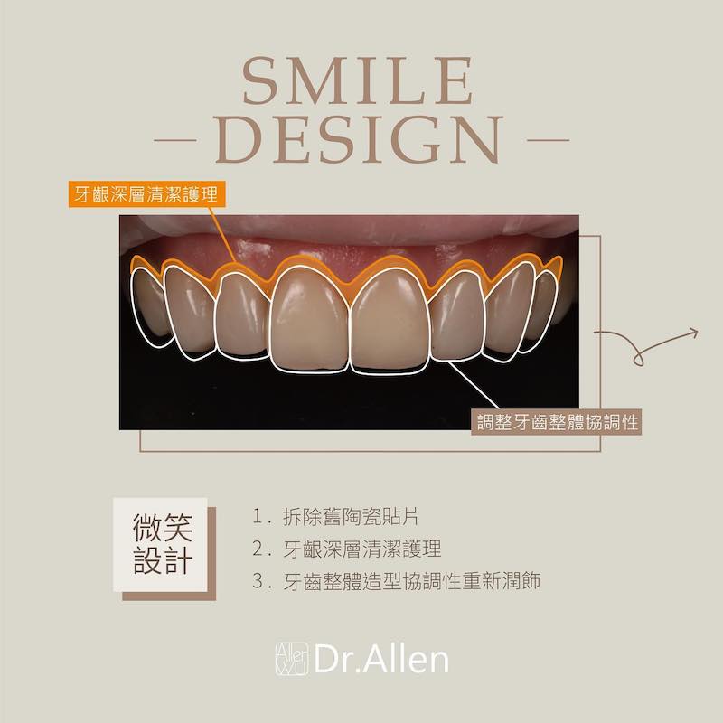 牙齒貼片-舊貼片拆除-牙齦護理-微笑設計-吳國綸醫師-台中