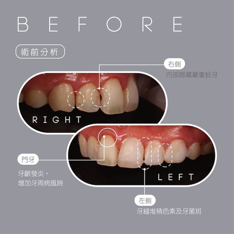 美白齒雕-牙齒貼片後遺症-蛀牙-牙齦發炎-陶瓷貼片療程前-上排牙齒左右側-吳國綸醫師-台中