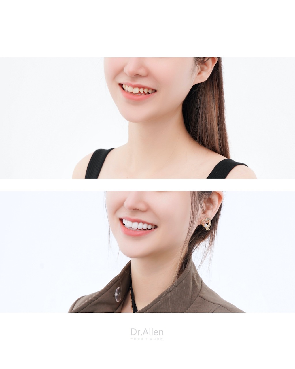 陶瓷貼片-牙齒形狀尖-牙齒黃-療程前後笑容比較-吳國綸醫師-台中