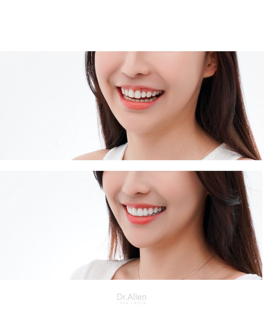 陶瓷貼片-牙齒黃-笑齦-牙齦整形-療程前後笑容比較-吳國綸醫師-台中