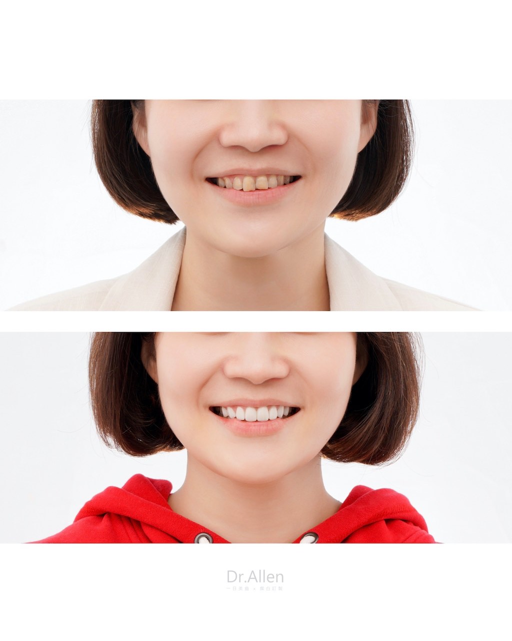 陶瓷貼片-門牙一長一短-牙齒黃-療程前後笑容比較-吳國綸醫師-台中