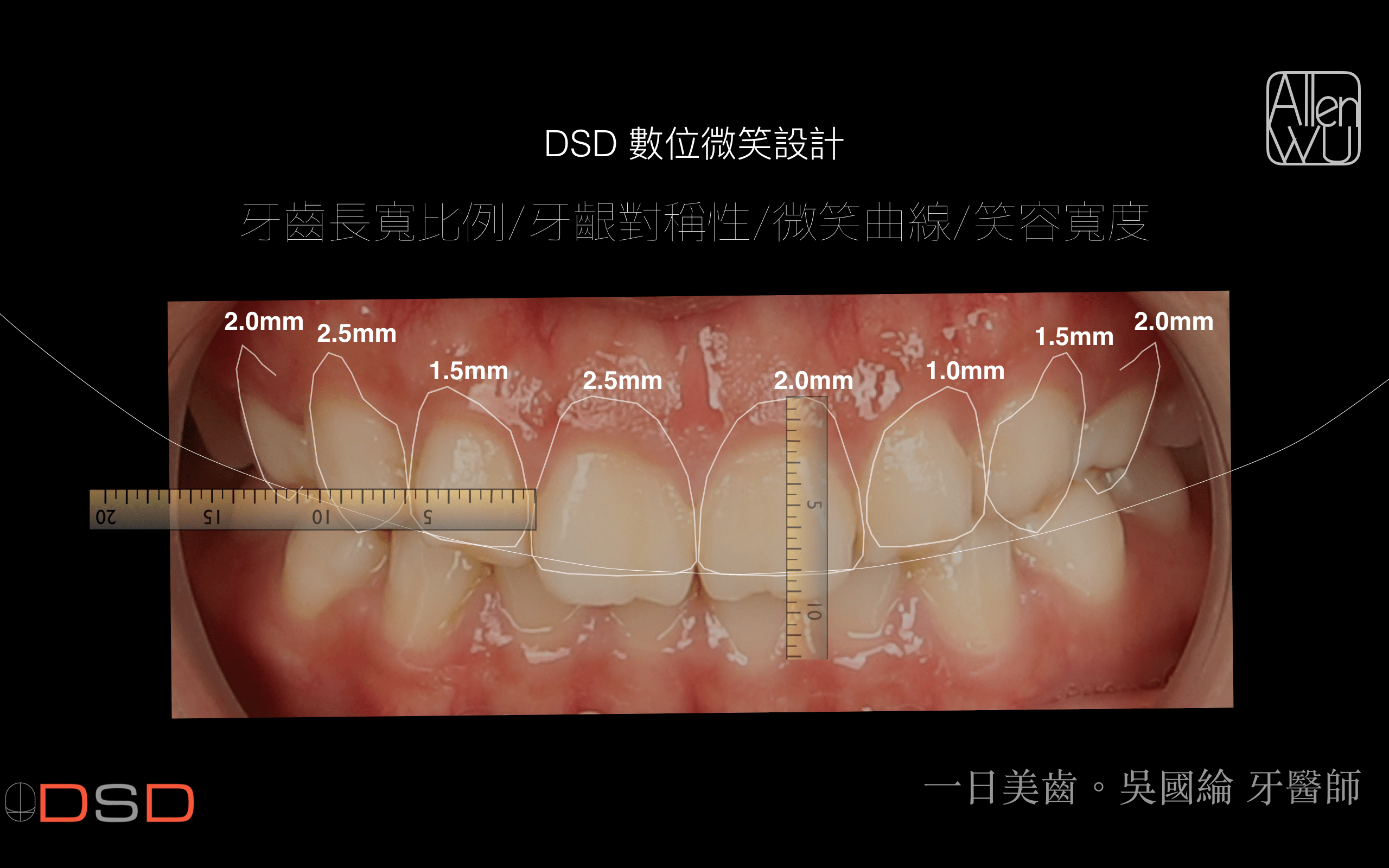 DSD微笑設計-DSD數位微笑設計-牙齒分析圖-吳國綸醫師-台中