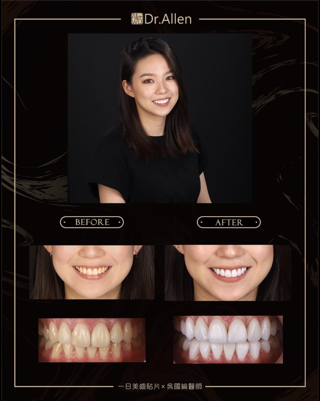 瓷牙貼片-DSD數位微笑設計-全瓷冠牙齒貼片推薦吳國綸醫師-網美人氣正妹牙齒美白心得