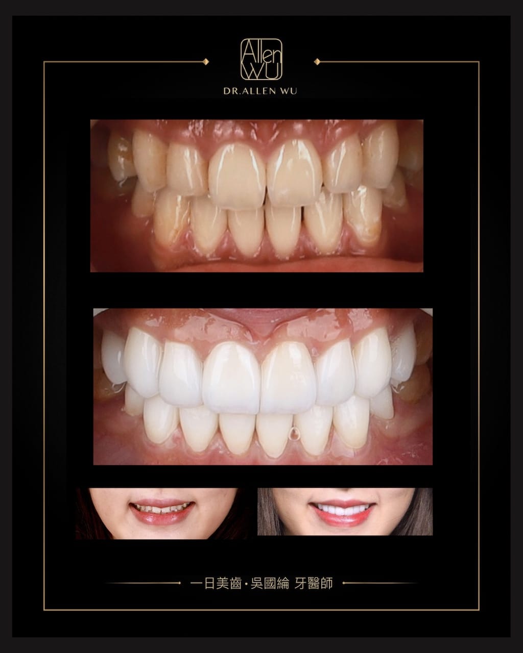 瓷牙貼片-DSD數位微笑設計-牙齒唇形-陶瓷貼片前後比較-牙齒美白貼片推薦專家-台中-吳國綸醫師