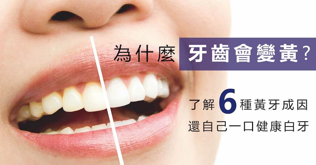 為什麼牙齒會變黃- 了解6種黃牙成因，再選擇健康的牙齒美白方法