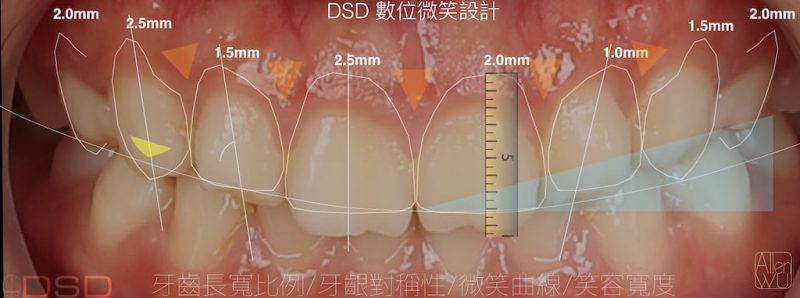 陶瓷貼片-DSD數位微笑設計-吳國綸醫師-台中