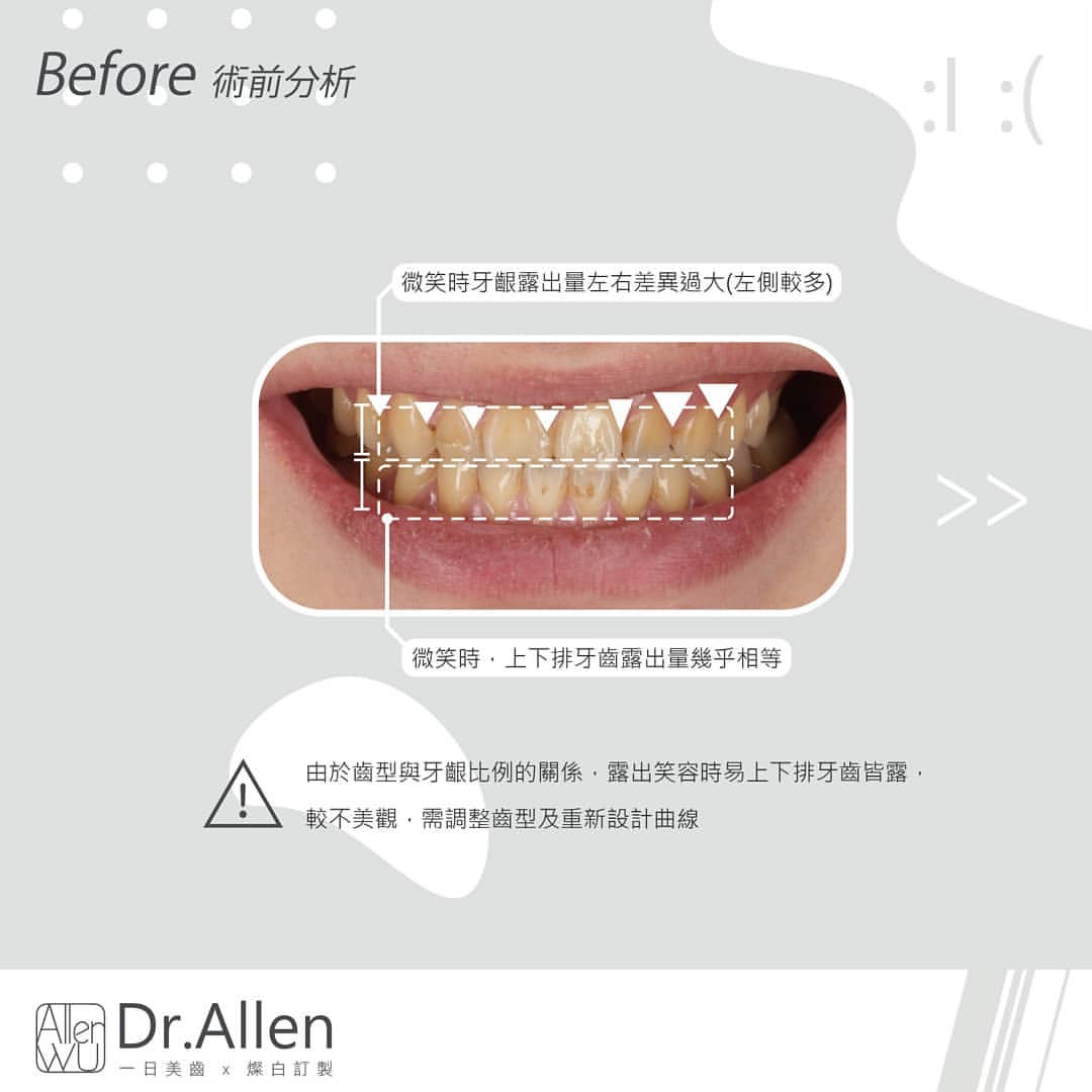 陶瓷貼片案例-療程前-牙齒形狀-牙齦比例不佳