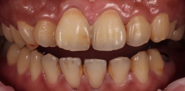牙齒美白貼片-牙齒矯正-牙齒整形優缺點-患者有前牙角度傾斜與門牙突出的問題