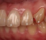 牙齒美白貼片-牙齒矯正-牙齒整形優缺點-患者有暴牙歪斜牙齒黃等多重影響美觀的不良元素