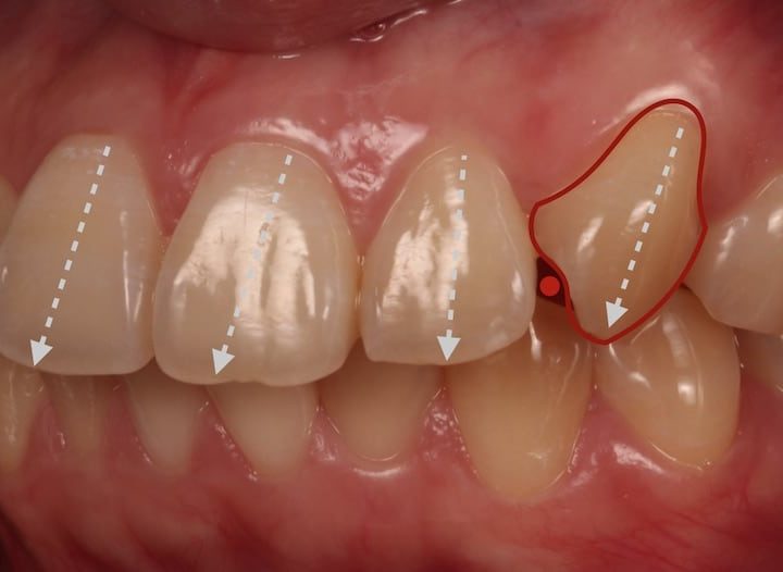 牙齒美白貼片-牙齒矯正-牙齒整形優缺點-患者有暴牙歪斜牙齒黃等多重影響美觀的不良元素