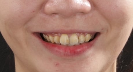 牙齒美白貼片-牙齒矯正-牙齒整形優缺點-患者有門牙暴牙虎牙內旋後縮問題-牙齒整形前照