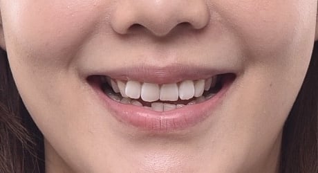 牙齒美白貼片-牙齒矯正-牙齒整形優缺點-患者有門牙歪斜虎牙內旋後縮問題-牙齒整形前照