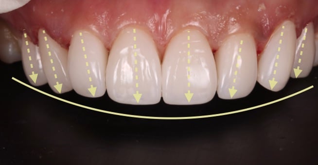 牙齒美白貼片-牙齒矯正-牙齒整形優缺點-患者用陶瓷貼片與數位全瓷冠調整門牙走向長度
