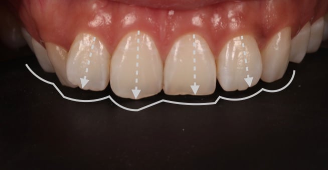 牙齒美白貼片-牙齒矯正-牙齒整形優缺點-患者經DSD數位微笑設計分析後有門牙歪斜與虎牙後縮問題