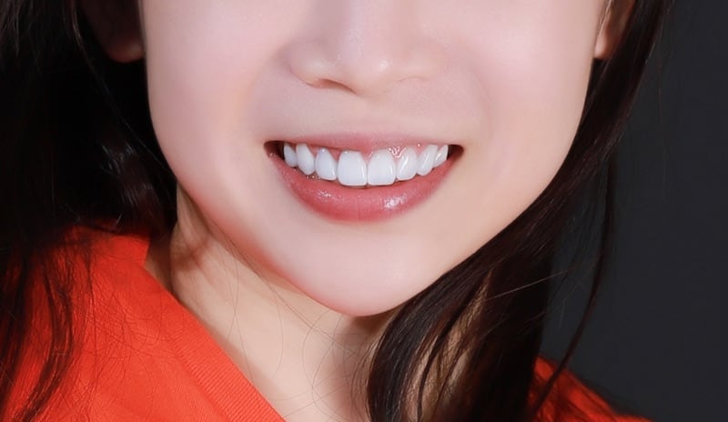 牙齒美白貼片-牙齒矯正-牙齒整形優缺點-採用DSD數位微笑分析與陶瓷貼片快速完成牙齒矯正與牙齒美白-患者術後照