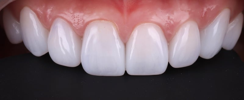 牙齒美白貼片-牙齒矯正-牙齒整形優缺點-採用DSD數位微笑分析與陶瓷貼片快速完成牙齒矯正與牙齒美白-療程後