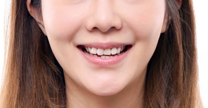 牙齒美白貼片-牙齒矯正-牙齒整形優缺點-採用陶瓷貼片與數位全瓷冠當天改善牙齒不整並同時牙齒美白-療程前