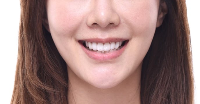 牙齒美白貼片-牙齒矯正-牙齒整形優缺點-採用陶瓷貼片與數位全瓷冠當天改善牙齒不整並同時牙齒美白-療程後