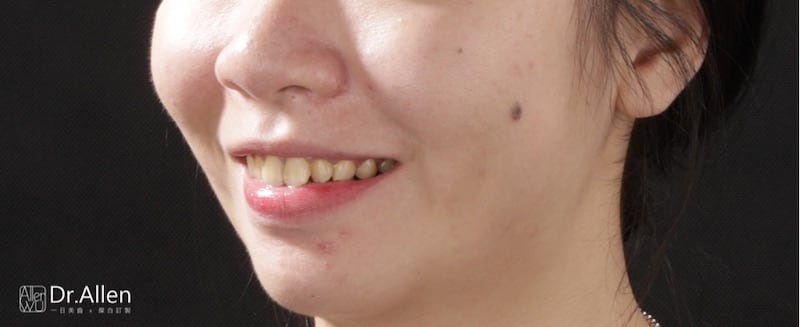牙齒美白貼片-牙齒矯正-牙齒整形優缺點-門牙區使用數位全瓷冠搭配中段陶瓷貼片大幅改變排列不整與暴牙-患者術前照