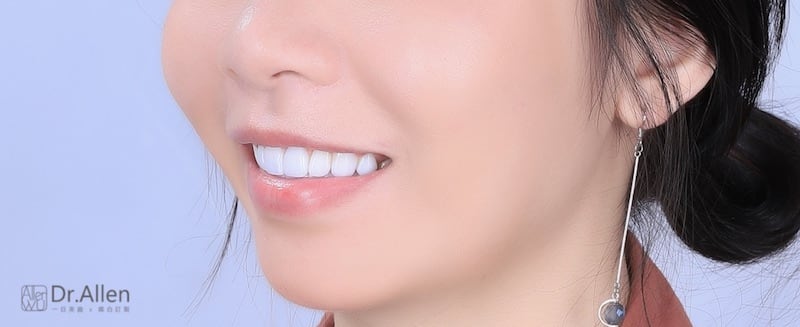 牙齒美白貼片-牙齒矯正-牙齒整形優缺點-門牙區使用數位全瓷冠搭配中段陶瓷貼片大幅改變排列不整與暴牙-患者術後照