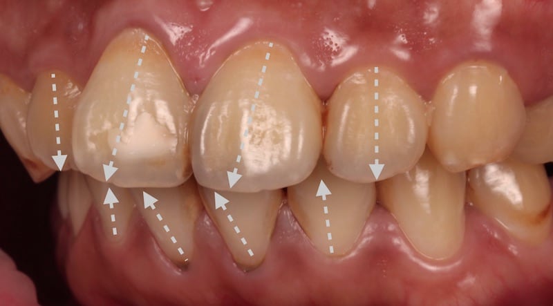 牙齒美白貼片-牙齒矯正-牙齒整形優缺點-門牙區使用數位全瓷冠搭配中段陶瓷貼片大幅改變排列不整與暴牙-療程前