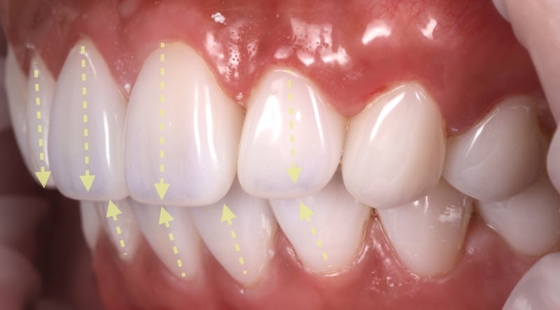 牙齒美白貼片-牙齒矯正-牙齒整形優缺點-門牙區使用數位全瓷冠搭配中段陶瓷貼片大幅改變排列不整與暴牙-療程後