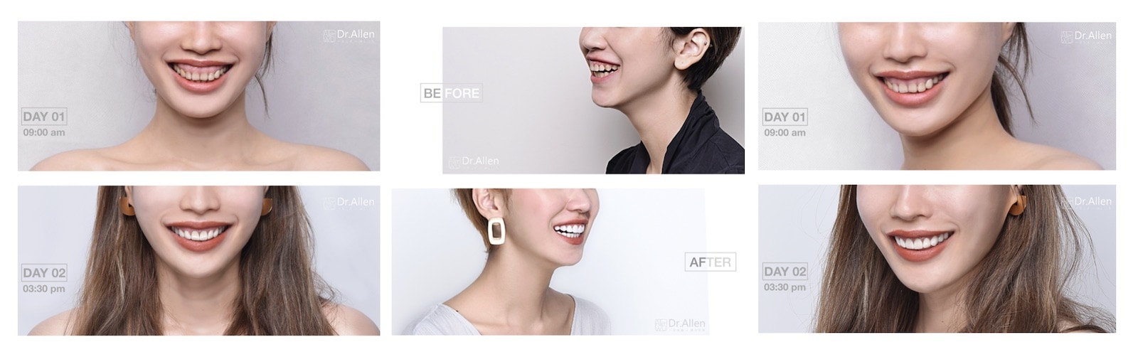 牙冠增長術-牙齦外露-陶瓷貼片-台中牙醫-吳國綸牙醫