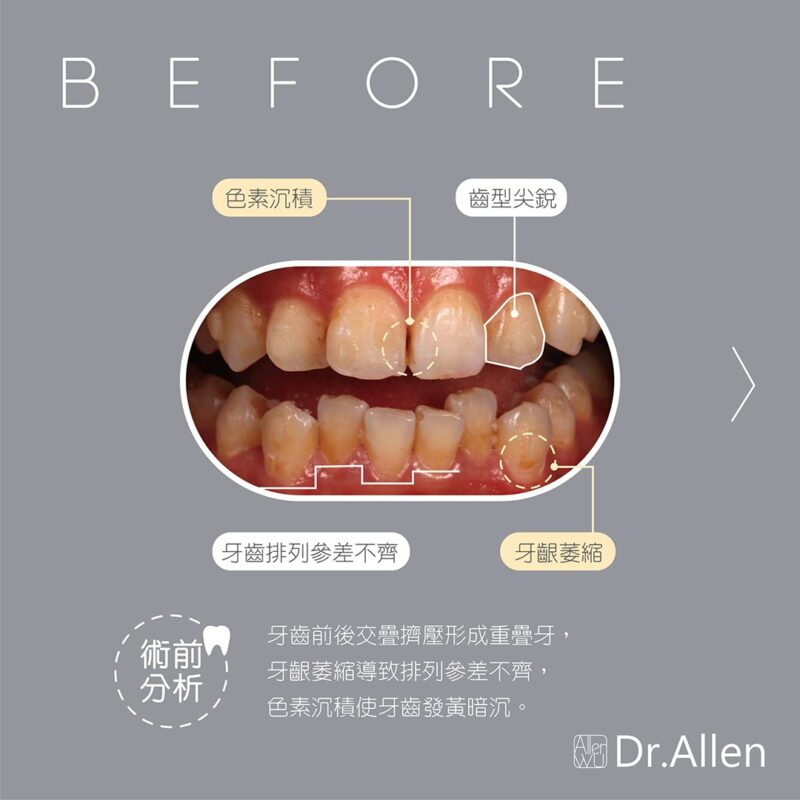 陶瓷貼片療程前-牙齒黃-齒列不整-牙齦萎縮-牙齒形狀尖銳