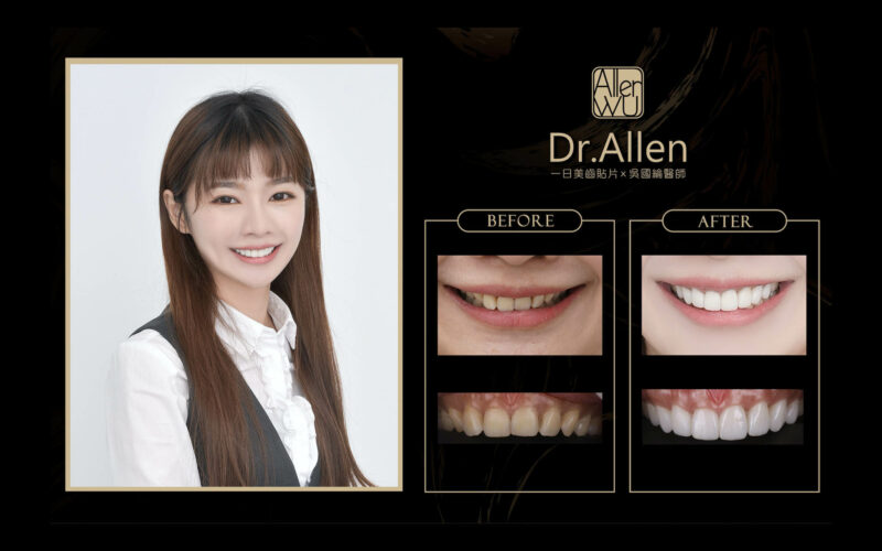 牙齒旋轉-牙齒不整齊-DSD數位微笑設計-陶瓷貼片療程前後比較-吳國綸醫師-台中