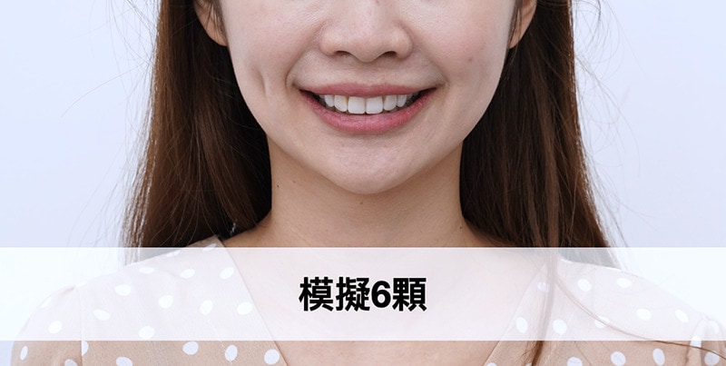 牙齒旋轉-牙齒不整齊-DSD數位微笑設計-模擬試戴6顆陶瓷貼片-吳國綸醫師-台中