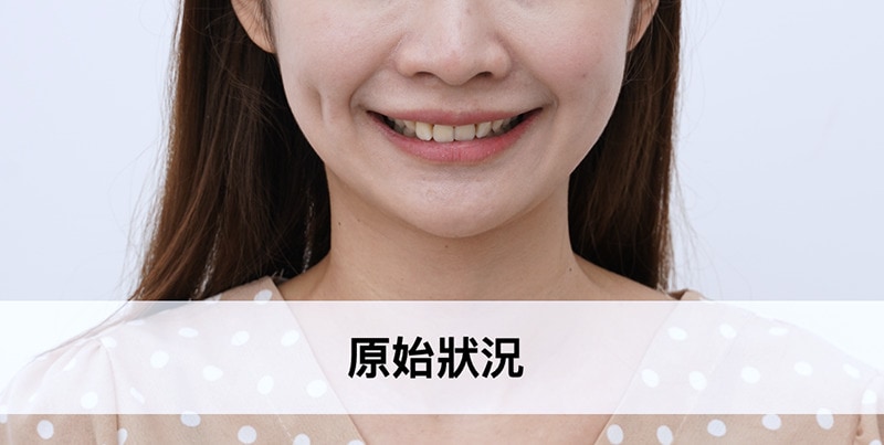 牙齒旋轉-牙齒不整齊-陶瓷貼片術前患者笑容-吳國綸醫師-台中