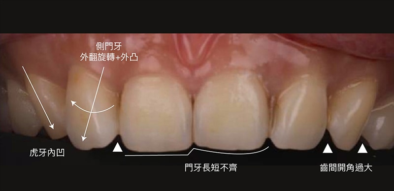 牙齒旋轉-牙齒不整齊-陶瓷貼片術前上排牙齒-吳國綸醫師-台中