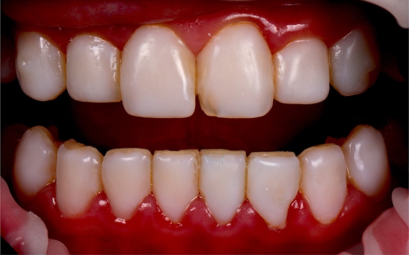 美白齒雕-不良牙齒貼片拆除前-吳國綸醫師-台中
