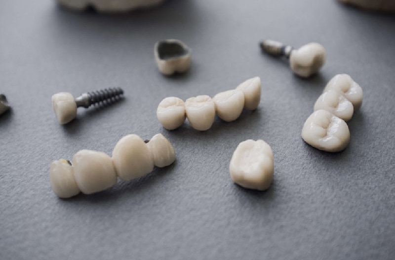 3D齒雕-全瓷嵌體-台中牙齒美白-推薦-牙醫-吳國綸醫師