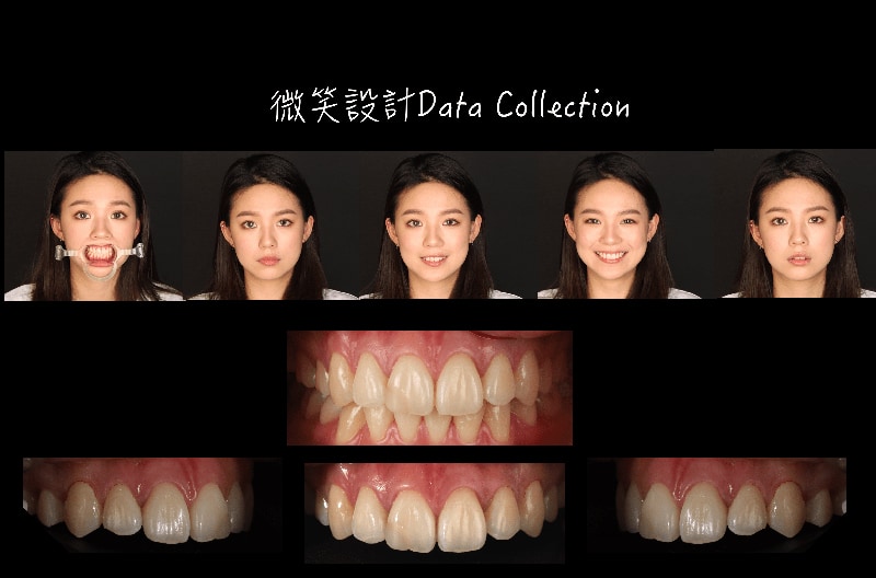 DSD微笑設計-台中陶瓷貼片推薦-吳國綸醫師