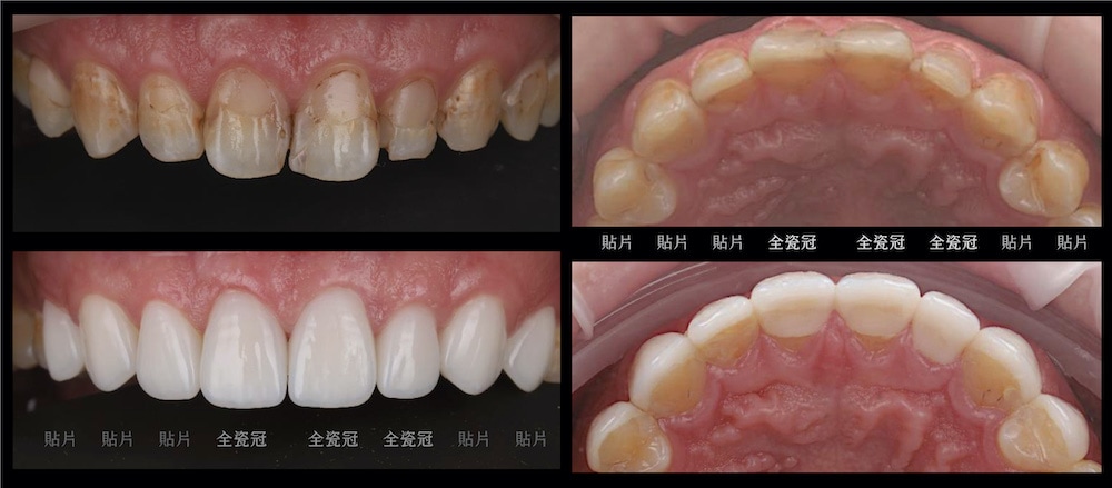 陶瓷貼片-全瓷冠-牙齒矯正-蛀牙-牙齒黃-治療前後比較-台中-吳國綸醫師