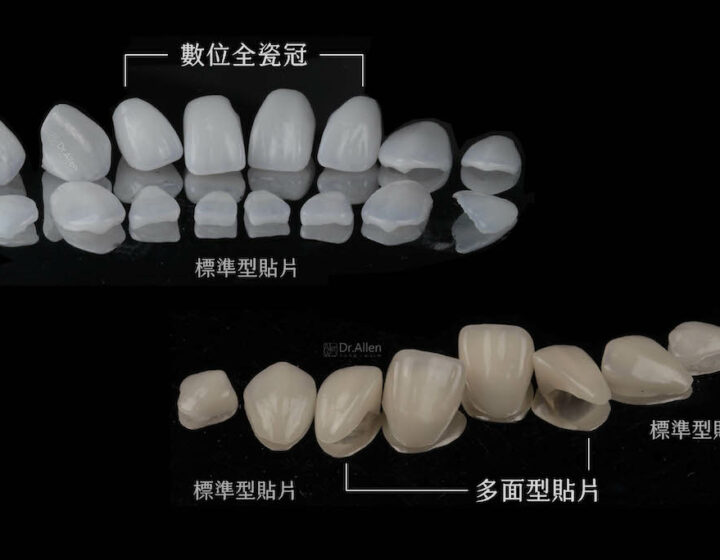 陶瓷貼片-全瓷冠-牙齒矯正-蛀牙-牙齒黃-牙齒美白推薦-台中-吳國綸醫師