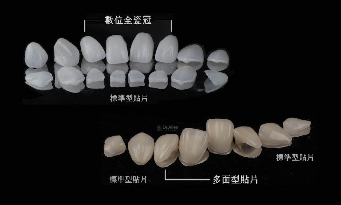 陶瓷貼片-全瓷冠-牙齒矯正-蛀牙-牙齒黃-牙齒美白推薦-台中-吳國綸醫師